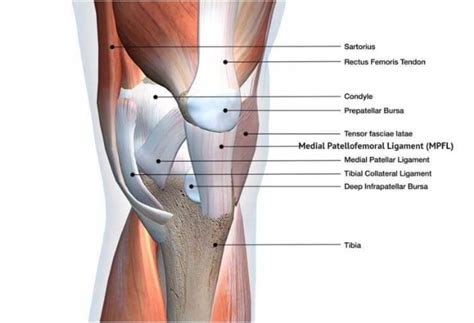 MEDIAL PATELLOFEMORAL LIGAMENT (MPFL) RECONSTRUCTION SURGERY - Midwest Orthopaedics