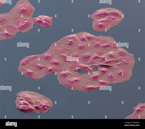 Coloured Scanning Electron Micrograph Sem Of Ovarian Cancer Cells The Cause Of Ovarian Cancer