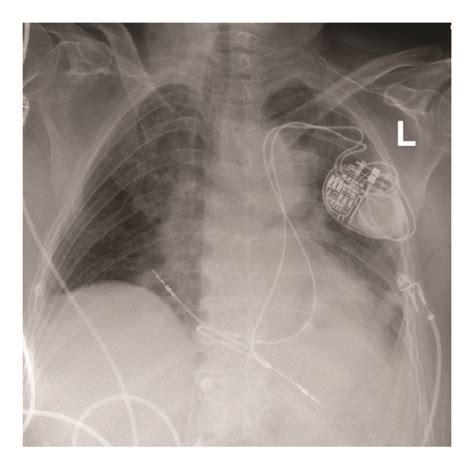 Chest X Ray With Pacemaker