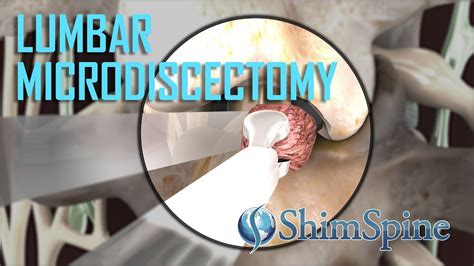 Lumbar Microdiscectomy Youtube