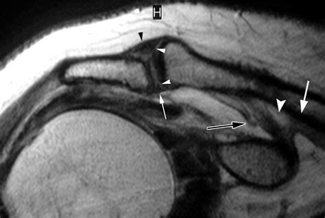 Mr Imaging Appearances Of Acromioclavicular Joint Dislocation