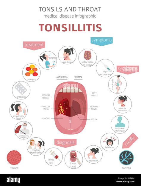 Enfermedades De La Garganta Y Las Am Gdalas Los S Ntomas De La
