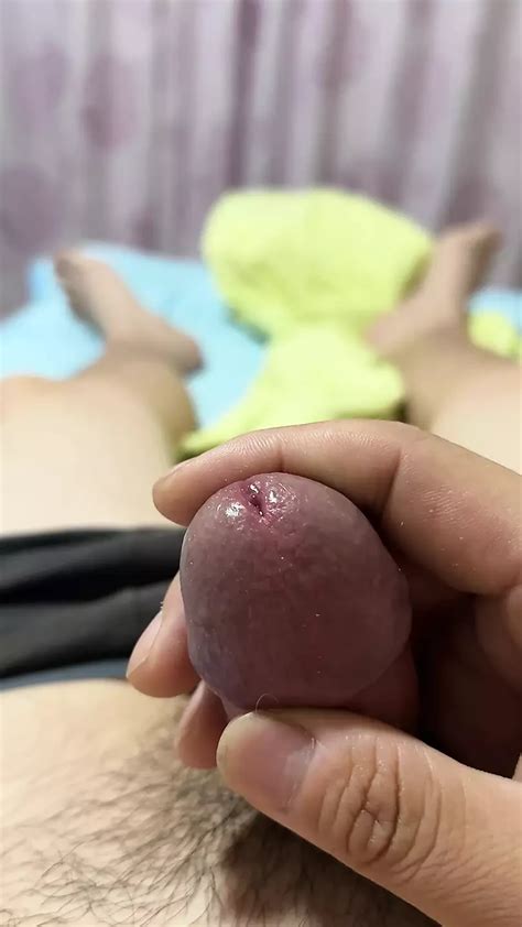 Penis After Phimosis Surgery Gay Amateur Amateur Porn Feat Group XHamster