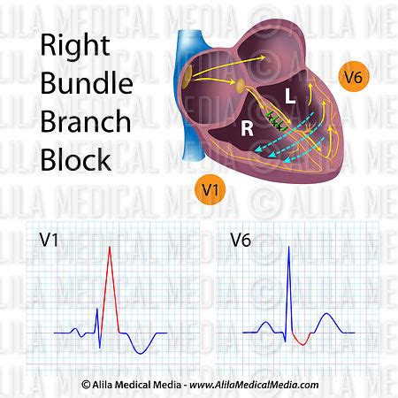 Alila Medical Media Right Bundle Branch Blocks Rbbb Medical