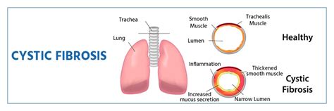 cystic fibrosis symptoms  diagnosis  treatment