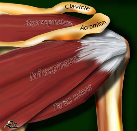 Distal Infraspinatus Tendinopathy