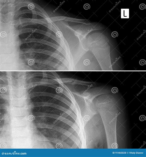 X-ray of the Left Collarbone. Fracture of Clavicle. Consolidation of