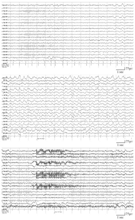 Electroencephalography Eeg Findings Download Scientific Diagram