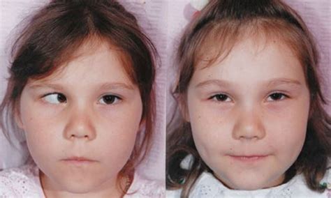 Лечение косоглазия в Николаеве (Лечение косоглазия) - Детский ...