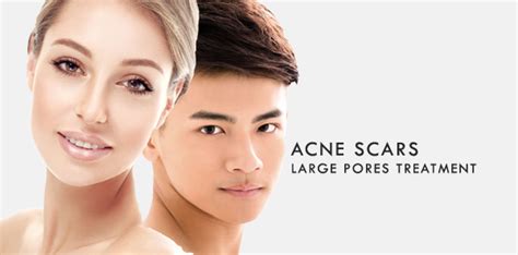 Acne Scar Treatment Sydney Large Pores Treatment