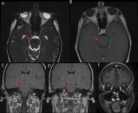 Teaching Neuroimages Trochlear Nerve Schwannoma Neurology