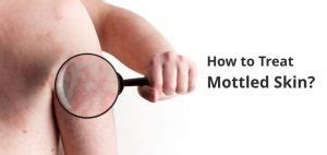 Mottled Skin (Livedo Reticularis): 8 Causes and Home Remedies