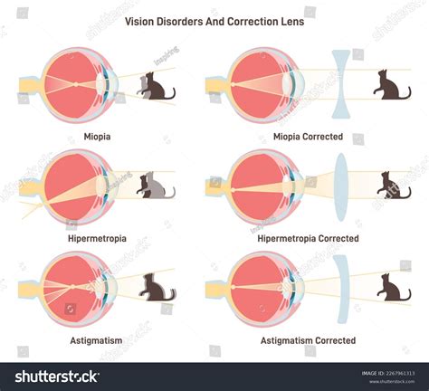 Myopia Hyperopia Astigmatism Common Vision Disorders Stock Vector