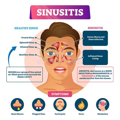 Sinusitis Stock Illustrations Sinusitis Stock Illustrations