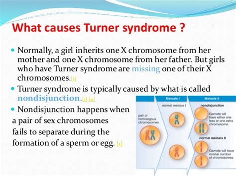 Chromosome Makeup Of Turner Syndrome | Makeupview.co