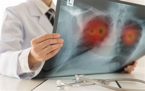 Med Journal 360 Risk Factors For Postop Acute Exacerbation In Patients With Lung Cancer With