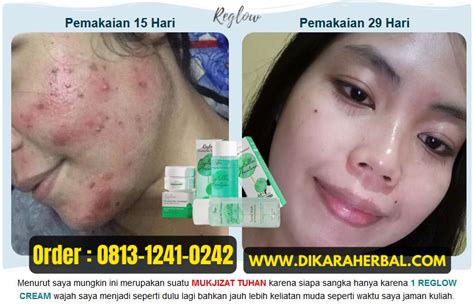 Lady Cream Skin Care Aman Atau Tidak Homecare24