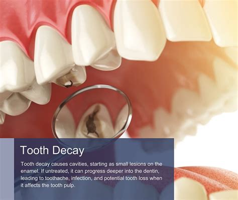 Tooth Decay Treatment NyС Reverse Teeth Decay In Brooklyn Manhattan