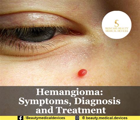 Hemangioma: Symptoms, Diagnosis and Treatment