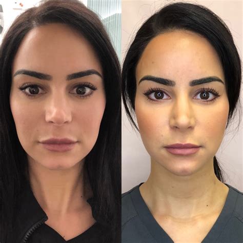 kybella    beauty boost med spa