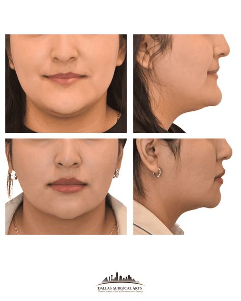 Face Shape Types And Aesthetic Treatments
