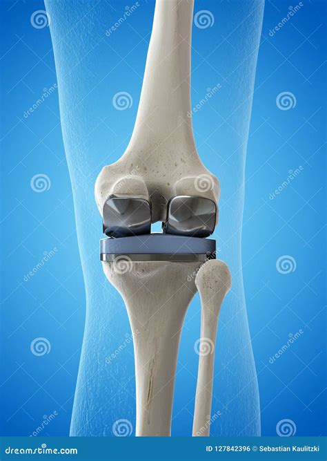 Implants Knee Of Metal And Plastic,The Knee Prosthesis Replaces The