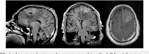 Figure 1 From A Case Of Frontal Meningioma Presenting As Frontal Lobe