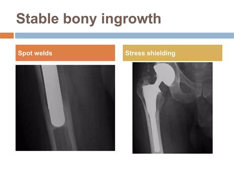 Aseptic loosening total hip arthroplasty | PPTX