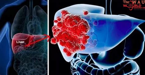 Liver Cancer Types And Stages