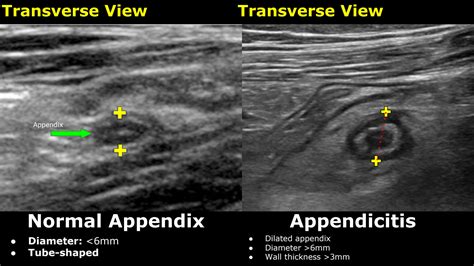 SOLUTION: Appendix Ultrasound Normal Vs Abnormal Image Appearances ...