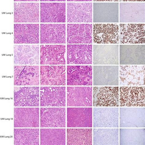 Histopathologic Features Of Nine Patient Non Small Cell Lung Cancer