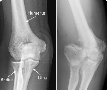 Distal Humerus Fracture Diagnosis Boston Medical Center