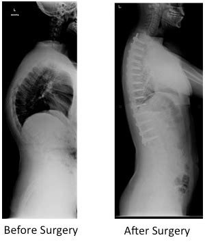 Posterior Spinal Instrumented Fusion For Scheuermanns Kyphosis