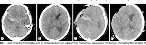 Figure 1 From Unexpected Severe Cerebral Edema After Cranioplasty Case Report And Literature