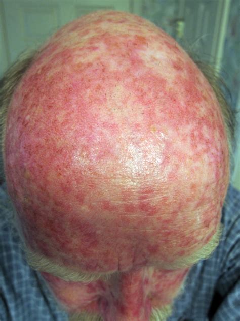 Efudex Round Two Day 14 Fully Cooked