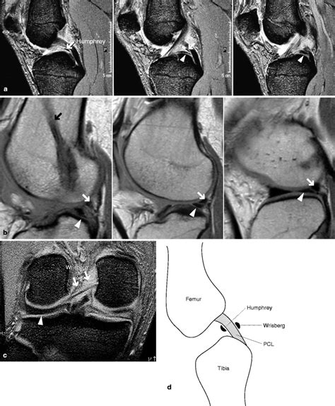 Xknee Startradiology Cruciate Ligament Radiology