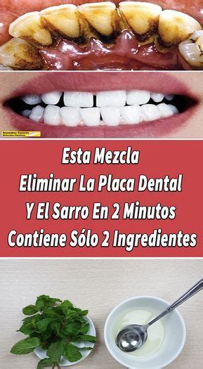 Esta Mezcla Eliminar La Placa Dental Y El Sarro En 2 Minutos