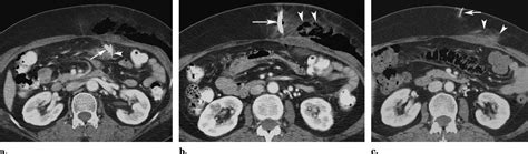 The One Anchor Technique Of Gastropexy For Percutaneous Radiologic