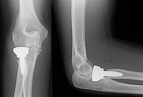 radial head fractures trauma orthobullets