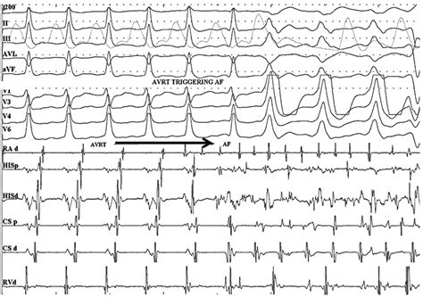 Risk Of Malignant Arrhythmias In Initially Symptomatic Patients With