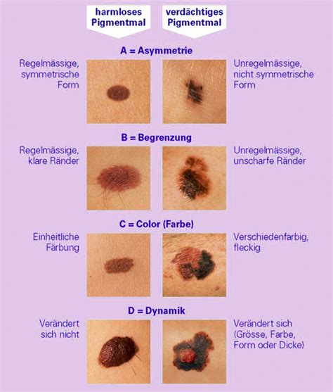 Ist Das Ein Gef Hrlicher Muttermal Leberfleck Gesundheit Und