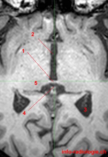 Anterior Commissure - Posterior Commissure - W-Radiology