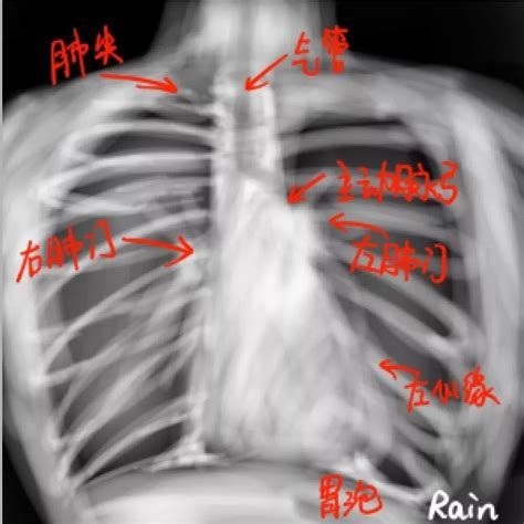 心脏杂音不会听？「6 部曲」帮你搞定 丁香园