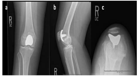 A B C Post Operative Right Knee Radiographs Demonstrating