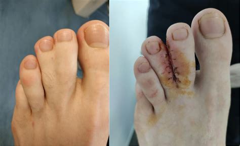 Webbed Toes Syndactyly Foot Podiatry Surgery