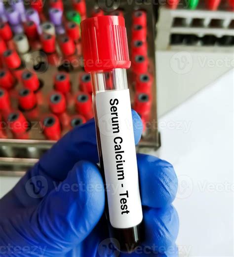 Blood sample for Serum calcium test. Bone disease diagnosis. 15605415 Stock Photo at Vecteezy