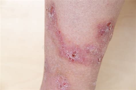 Rash Hives Itchy Skin On Legs Inflammation And Allergy Disease On