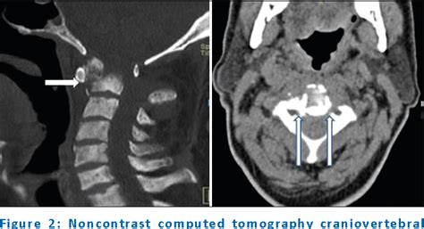 Figure 2 From Spastic Quadriparesis Due To Pathological Fracture Of