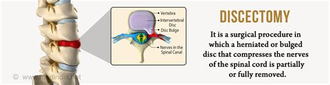 Discectomy Types Preparation Procedure Risk And Complications