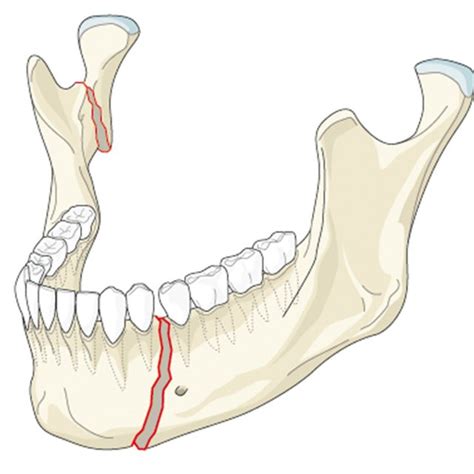 A Simultaneous Fracture Of The Mandibular Body And Ramus B The Download Scientific Diagram